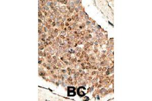 Formalin-fixed and paraffin-embedded human cancer tissue reacted with BMP10 polyclonal antibody  , which was peroxidase-conjugated to the secondary antibody, followed by DAB staining. (BMP10 Antikörper  (N-Term))