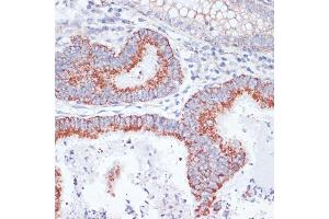 Immunohistochemistry of paraffin-embedded human colon carcinoma using CD71/Transferrin Receptor antibody (ABIN6131555, ABIN6149065, ABIN6149066 and ABIN6221572) at dilution of 1:100 (40x lens). (Transferrin Receptor Antikörper  (AA 1-140))