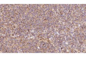 ABIN6273194 at 1/100 staining Human lymph cancer tissue by IHC-P. (ARL8B Antikörper  (Internal Region))