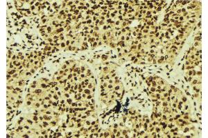 ABIN6268656 at 1/100 staining Human breast cancer tissue by IHC-P. (XBP1 Antikörper  (C-Term))