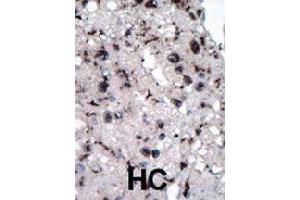 Formalin-fixed and paraffin-embedded human hepatocellular carcinoma tissue reacted with HK2 polyclonal antibody  , which was peroxidase-conjugated to the secondary antibody, followed by DAB staining. (Hexokinase 2 Antikörper  (Internal Region))