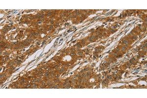 Immunohistochemistry of paraffin-embedded Human gasrtic cancer tissue using CYP27A1 Polyclonal Antibody at dilution 1:50 (CYP27A1 Antikörper)