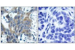Immunohistochemical analysis of paraffin-embedded human breast carcinoma tissue, using β-Catenin (phospho-Ser33) antibody (E011218). (beta Catenin Antikörper  (pSer33))