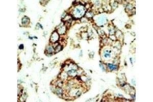 IHC analysis of FFPE human breast carcinoma tissue stained with the EphA2 antibody (EPH Receptor A2 Antikörper  (AA 30-60))