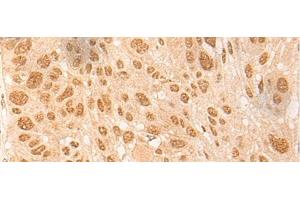Immunohistochemistry of paraffin-embedded Human esophagus cancer tissue using DBP Polyclonal Antibody at dilution of 1:25(x200) (DBP Antikörper)