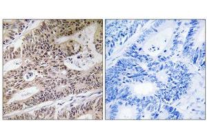 Immunohistochemistry analysis of paraffin-embedded human colon carcinoma tissue using NPHP4 antibody. (NPHP4 Antikörper  (Internal Region))