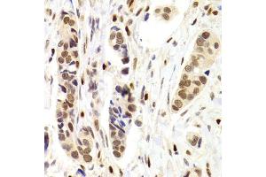 Immunohistochemistry of paraffin-embedded human breast cancer using NASP Antibody. (NASP Antikörper)