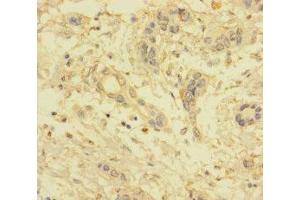 Immunohistochemistry of paraffin-embedded human pancreatic cancer using ABIN7175533 at dilution of 1:100 (VKORC1L1 Antikörper  (AA 38-91))