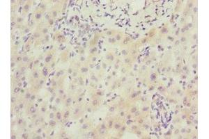 Immunohistochemistry of paraffin-embedded human liver cancer using ABIN7168604 at dilution of 1:100 (SCAND1 Antikörper  (AA 1-179))