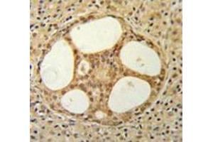 Immunohistochemistry analysis in prostate carcinoma (Formalin-fixed, Paraffin-embedded) using PRUNE  Antibody (C-term), followed by peroxidase conjugation of the secondary antibody and DAB staining. (PRUNE Antikörper  (C-Term))