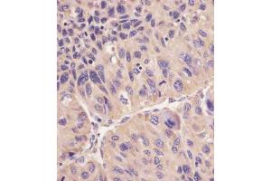 B staining hFACL4 in human human hepatocarcinoma sections by Immunohistochemistry (IHC-P - paraformaldehyde-fixed, paraffin-embedded sections). (ACSL4 Antikörper  (AA 236-267))