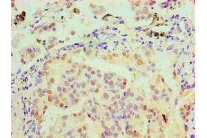 Immunohistochemical of paraffin-embedded Human lung cancer tissue using ABIN7160272 at dilution of 1:200. (MSH6 Antikörper)