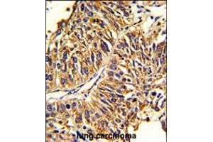 Formalin-fixed and paraffin-embedded human lung carcinoma reacted with HMGCS1 Antibody , which was peroxidase-conjugated to the secondary antibody, followed by DAB staining. (HMGCS1 Antikörper  (AA 290-317))