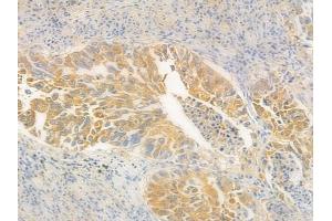 ABIN6265850 and ABIN6278111 at 1/100 staining human lung squamous cell carcinoma by IHC-P. (UBE2L3 Antikörper  (C-Term))