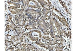 IHC analysis of ACLY using anti-ACLY antibody (ABIN4886416). (ACLY Antikörper  (AA 1-180))