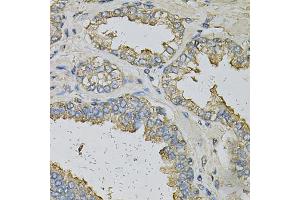 Immunohistochemistry of paraffin-embedded human prostate using ALDH3A1 Antibody (ABIN6290003) at dilution of 1:100 (40x lens). (ALDH3A1 Antikörper)