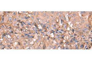 Immunohistochemistry of paraffin-embedded Human liver cancer tissue using NOTCH4 Polyclonal Antibody at dilution of 1:30(x200) (NOTCH4 Antikörper)