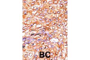 Formalin-fixed and paraffin-embedded human breast cancer tissue reacted with DUSP10 polyclonal antibody  , which was peroxidase-conjugated to the secondary antibody, followed by AEC staining. (DUSP10 Antikörper  (N-Term))