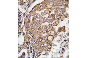 Formalin-fixed and paraffin-embedded human lung carcinoma tissue reacted with ALOX5 antibody (Center), which was peroxidase-conjugated to the secondary antibody, followed by DAB staining. (ALOX5AP Antikörper  (AA 86-117))