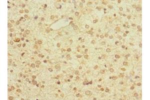 Immunohistochemistry of paraffin-embedded human glioma using ABIN7176525 at dilution of 1:100 (ZNF774 Antikörper  (AA 101-300))
