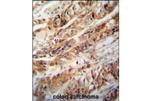 ZC3H15 antibody immunohistochemistry analysis in formalin fixed and paraffin embedded human colon carcinoma followed by peroxidase conjugation of the secondary antibody and DAB staining. (ZC3H15 Antikörper  (C-Term))