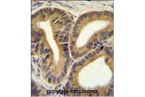 TRIM65 Antibody (Center) (ABIN655759 and ABIN2845202) immunohistochemistry analysis in formalin fixed and paraffin embedded human prostate carcinoma followed by peroxidase conjugation of the secondary antibody and DAB staining. (TRIM65 Antikörper  (AA 327-355))