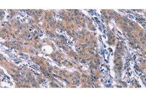 Immunohistochemistry of paraffin-embedded Human gasrtic cancer tissue using ESPL1 Polyclonal Antibody at dilution 1:40 (Separase Antikörper)