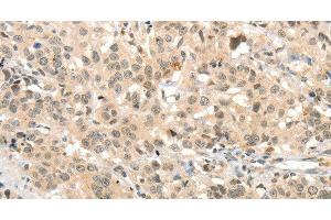 Immunohistochemistry of paraffin-embedded Human esophagus cancer tissue using TSPYL2 Polyclonal Antibody at dilution 1:30