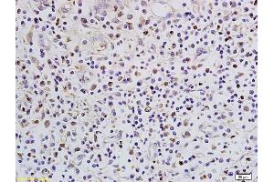 Formalin-fixed and paraffin embedded human colon cancer labeled with Anti-SATB1 Polyclonal Antibody, Unconjugated (ABIN732008) followed by conjugation to the secondary antibody and DAB staining