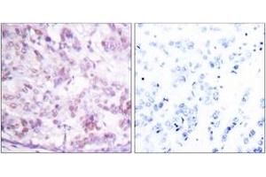 Immunohistochemistry analysis of paraffin-embedded human breast carcinoma tissue, using MYB (Ab-12) Antibody. (MYB Antikörper  (AA 1-50))