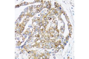 Immunohistochemistry of paraffin-embedded human liver cancer using BCAP29 antibody (ABIN5973749) at dilution of 1/100 (40x lens). (BCAP29 Antikörper)
