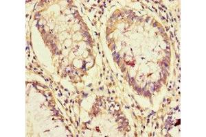 Immunohistochemistry of paraffin-embedded human colon cancer using ABIN7161865 at dilution of 1:100 (NCOA6 Antikörper  (AA 285-504))