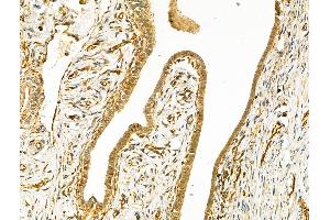 ABIN6259925 and ABIN6268670 at 1/100 staining Human ovarian cancer and adjacent normal tissues by IHC-P. (Angiopoietin 2 Antikörper  (N-Term))