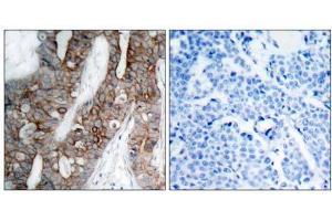 Immunohistochemical analysis of paraffin-embedded human breast carcinoma tissue using Integrin β3 (Ab-773) antibody (E021082). (Integrin beta 3 Antikörper)