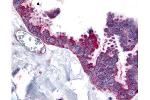 Anti-WNT2B antibody IHC of human Ovary, Carcinoma. (WNT2B Antikörper  (N-Term))