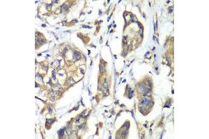 Immunohistochemistry of paraffin-embedded human liver cancer using NFS1 antibody at dilution of 1:100 (x40 lens). (NFS1 Antikörper)