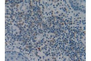 IHC-P analysis of Human Skin cancer Tissue, with DAB staining. (Fibrillin 1 Antikörper  (AA 723-902))