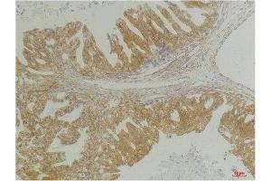 Immunohistochemistry (IHC) analysis of paraffin-embedded Human Breast Carcinoma using CXCR4 Rabbit Polyclonal Antibody diluted at 1:200. (CXCR4 Antikörper)