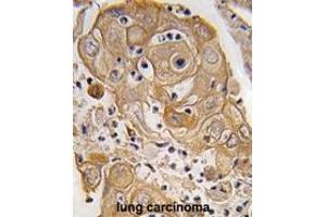 Formalin-fixed and paraffin-embedded human lung carcinoma tissue reacted with PTRF antibody (N-term) (ABIN391621 and ABIN2841540) , which was peroxidase-conjugated to the secondary antibody, followed by DAB staining. (PTRF Antikörper  (N-Term))