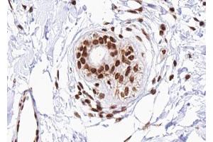 ABIN6267488 at 1/100 staining human Breast carcinoma tissue sections by IHC-P. (DDIT3 Antikörper  (pSer30))