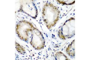 Immunohistochemistry of paraffin-embedded human colon carcinoma using SS18 antibody (ABIN5975075) at dilution of 1/200 (40x lens). (SS18 Antikörper)