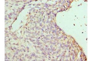 Immunohistochemistry of paraffin-embedded human endometrial cancer using ABIN7155457 at dilution of 1:100 (RBBP7 Antikörper  (AA 1-230))