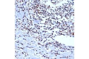 Immunohistochemistry of paraffin-embedded human esophageal cancer using A Rabbit mAb (ABIN7265387) at dilution of 1:100 (40x lens). (BAF53A Antikörper)
