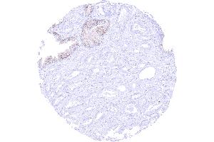 CD38 negative prostatic adenocarcinoma Gleason 336 adjacent to CD38 positive normal epithelium