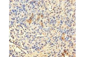 Immunohistochemistry of paraffin-embedded human bladder cancer using ABIN7172423 at dilution of 1:100 (TCEANC2 Antikörper  (N-Term))