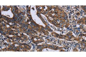 Immunohistochemistry of paraffin-embedded Human gastic cancer using LZTFL1 Polyclonal Antibody at dilution of 1:50 (LZTFL1 Antikörper)