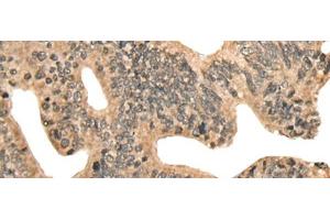 Immunohistochemistry of paraffin-embedded Human colorectal cancer tissue using CCNB1IP1 Polyclonal Antibody at dilution of 1:30(x200) (CCNB1IP1 Antikörper)