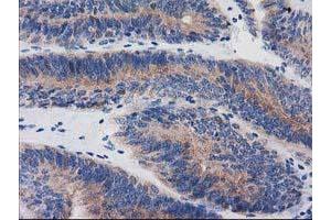 Immunohistochemical staining of paraffin-embedded Adenocarcinoma of Human endometrium tissue using anti-BIN3 mouse monoclonal antibody. (BIN3 Antikörper)