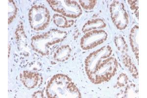 Formalin-fixed, paraffin-embedded human Prostate Carcinoma stained with ATRX Rabbit Recombinant Monoclonal Antibody (ATRX/2900R). (Rekombinanter ATRX Antikörper)