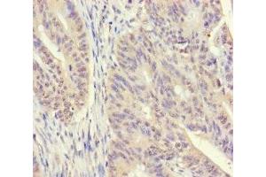Immunohistochemistry of paraffin-embedded human colon cancer using ABIN7170541 at dilution of 1:100 (Spermidine Synthase Antikörper  (AA 17-302))